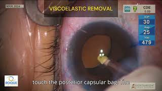 Viscoelastic removal [upl. by Lavoie]