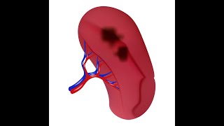 Splenic infarction  Spleen Infarction  Definition Causes Symptoms Diagnosis Treatment [upl. by Errehs]