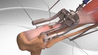 Achilles Tendon Rupture Repair with Arthrex® PARS System [upl. by Rimola]