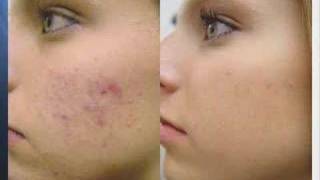 Acne Treatment with Fotona Laser [upl. by Downs]