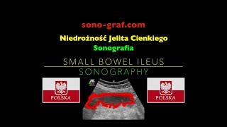 Sonografia  Niedrożność Jelita Cienkiego [upl. by Maise314]