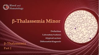 BetaThalassemia part 2  BetaThalassemia Minor [upl. by Tadio]