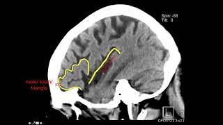 Introduction to Brain Surface Anatomy [upl. by Nosbig381]