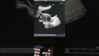 Dermoid cyst in Right ovary by Medical Radiology [upl. by Nashbar]