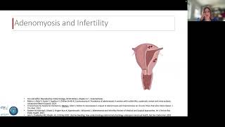 Endometriosis and Adenomyosis impact on Implantation  L Henry Liege [upl. by Adnohsat]