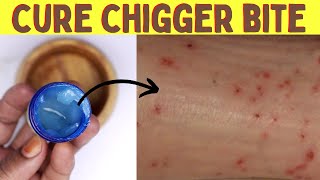 How to get rid of chigger bites on your body and skin naturally at home [upl. by Maharg945]