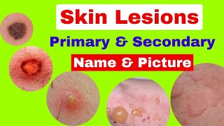 Type of skin lesions with name and picture  Primary and secondary skin lesions  skin diseases [upl. by Thedric]