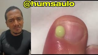 UNHA ENCRAVADA E INFLAMADA viral [upl. by Dnaleel]