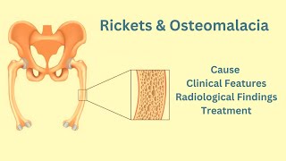 Rickets amp Osteomalacia Causes Clinical features Radiological features Treatment [upl. by Perot458]