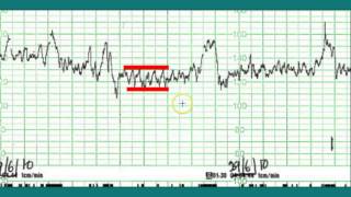 Ctg interpretation  Normal CTG [upl. by Froma210]