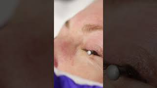 Eye Wrinkles Treatment with Ablative Co2 Laser [upl. by Pulling]