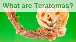 What are Teratomas  Pathology mini tutorial [upl. by Oeramed434]