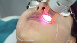 Laser hair removal for face [upl. by Traci]