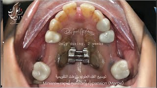 Miniscrew assessed rapid palatal expansion MARPE التوسيع العظمي بالزرعات التقويمية بدون عملية جراحية [upl. by Nairadas]