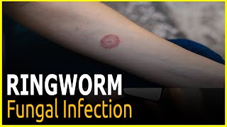 Ringworm What to know and do ringowrm treatments medicine [upl. by Gamber]