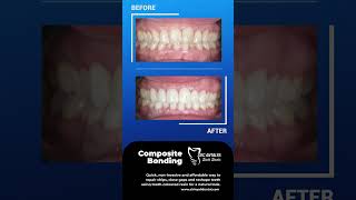 Transform Your Smile with Composite Bonding  Fast and Effective Tooth Repair compositebonding [upl. by Yesiad]