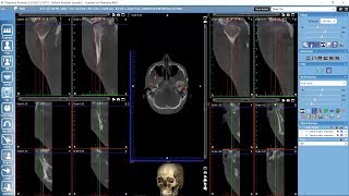 Planmeca Romexis TMJ module [upl. by Etnomed47]