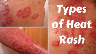 Types of Heat Rash [upl. by Laeynad]