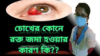 What is subconjunctival hemorrhage Causes amp Treatment in Bengali  in details [upl. by Atsillac]