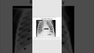 Rachitic rosaryricketsradiology neetpg [upl. by Esinek]