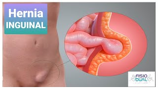 Ejercicios para Hernia Inguinal [upl. by Kwarteng86]