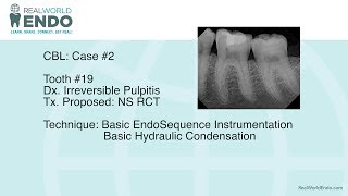 CBL 2 Basic Molar Root Canal Therapy 19 by RealWorldEndo [upl. by Spike]