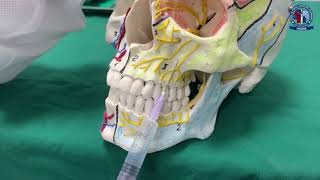 Middle Superior Alveolar nerve block [upl. by Brnaba643]