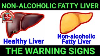 6 Warning Signs Of Nonalcoholic Fatty Liver Disease [upl. by Tenner]