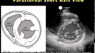 Video procedurale Ecografia cardiaca  Asse corto parasternale [upl. by Adnuahsor]