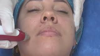 Tratamiento facial con Dermapen [upl. by Stephani764]