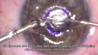 Descemetorhexis Without Endothelial Keratoplasty DWEK Descemet stripping only DSO [upl. by Magan146]