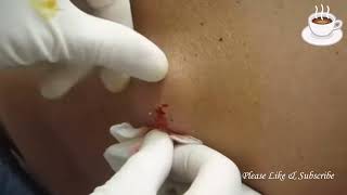 Pimple Pop React Huge Back Cyst [upl. by Roel]