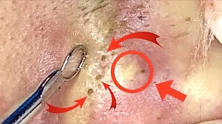 😍 Skin Care Pimple Extraction Facial Blackhead Removal with quotEchoes of Departure Historyquot [upl. by Anelah707]