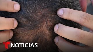 La FDA aprueba un medicamento contra la alopecia  Noticias Telemundo [upl. by Chiquia360]