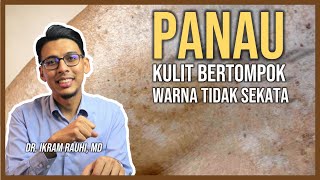 Rawatan Penyakit Panau  Apa dan Bagaimana Panau Terjadi Cara Mengatasi Panau di Muka dan Badan [upl. by Ytsihc]