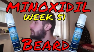 Minoxidil Beard Growth Results  Week 51  Minoxidil 5 for Beard Growth  Facialfuzzfridays [upl. by Schlenger]