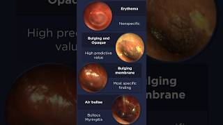 Acute Otitis Media Otoscopy [upl. by Doane186]