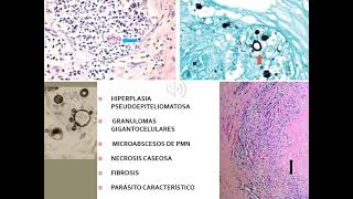 3 Paracoccidioidomicosis [upl. by Ahsienod]