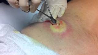 Lancing infected cyst  abscess [upl. by Nirol]