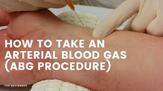 How to take blood for ABG Arterial blood gas [upl. by Hertzog923]