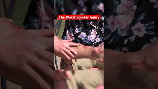 The WORST Scooter Injuries of All Time… funny science comedy [upl. by Dalpe671]