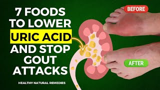 7 Incredible Foods To Lower Uric Acid and Stop Gout Attacks [upl. by Eojyllib868]