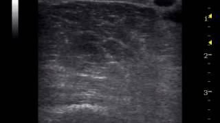 tromboflebite superficiale da cvp emergency ultrasound [upl. by Ettedanreb323]