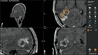 Smartbrush—Volumetric Tumor Outlining by Brainlab [upl. by Nadaba]