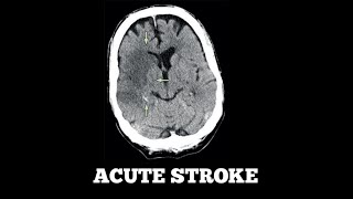 Acute Stroke Case Discussion [upl. by Ahsemo]