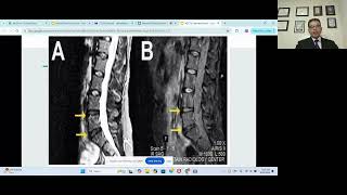 Navneet bodduRole of mesenchymal stemcells for systemic illnesses [upl. by Yeliab]