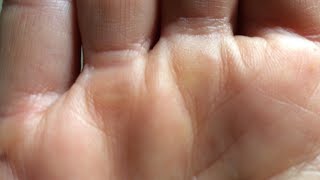 how to get rid of calluses on your hands from lifting [upl. by Gombosi308]