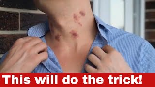 How to Get Rid of Hickeys  11 Proven Methods to Clear Your Skin Quickly [upl. by Dwain]