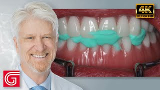 Restoration of Implant Overdentures by Timothy Kosinski DDS MAGD [upl. by Annauj]