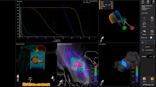 Radiosurgery Solution for the Treatment of Cranial Indications  Elements Cranial SRS [upl. by Iak]